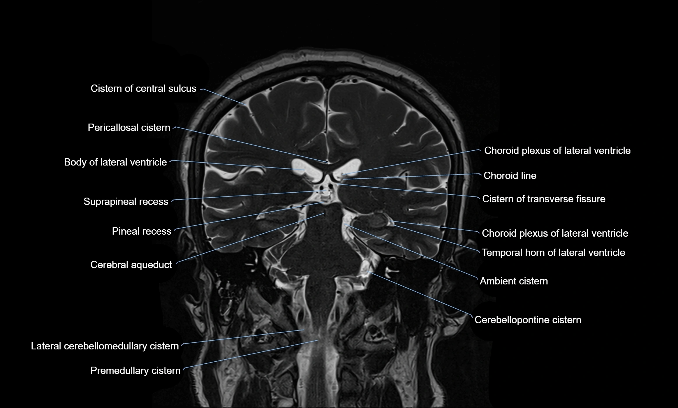 Brain cisterns  and ventricles coronal anatomy 3T MRI image-img-00001-00036.webp